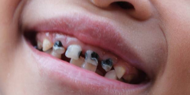 亚裔儿童龋齿率达44%,因伤入院儿童应同时接受牙齿健康检查 